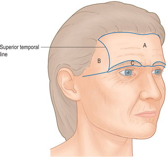 forehead brow lift temporal line temple techniques lateral anatomy medical eyebrow central superior regions subunits separates note figure gr2 plasticsurgerykey