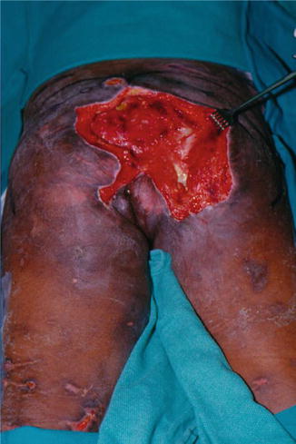 Etiology And Pathology Of Pressure Ulcers Plastic Surgery Key