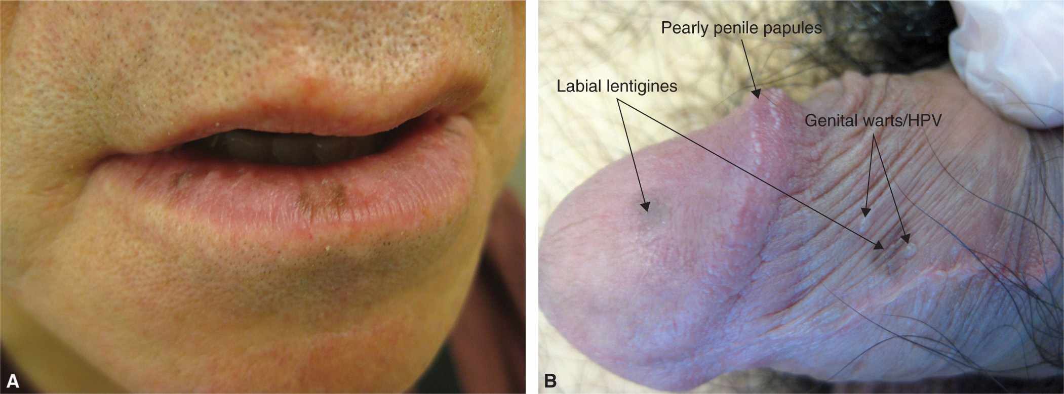 brown spot on lip