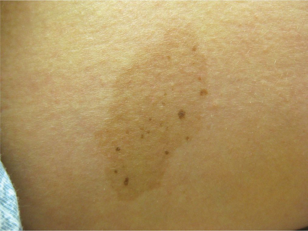 pigmented-lesions-and-melanoma-plastic-surgery-key