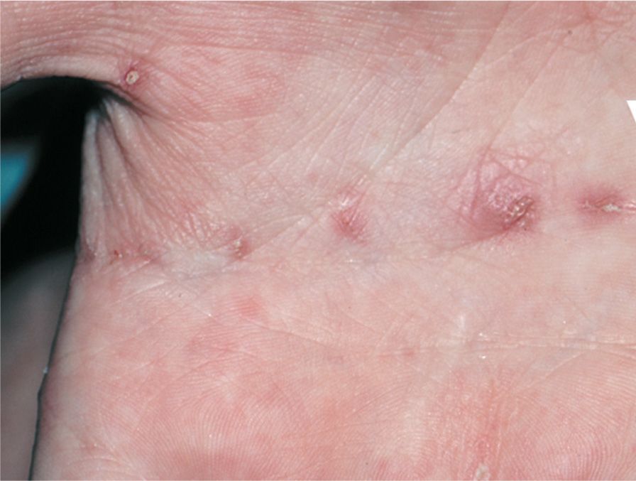  How Long Is Scabies Contagious After Treatment 