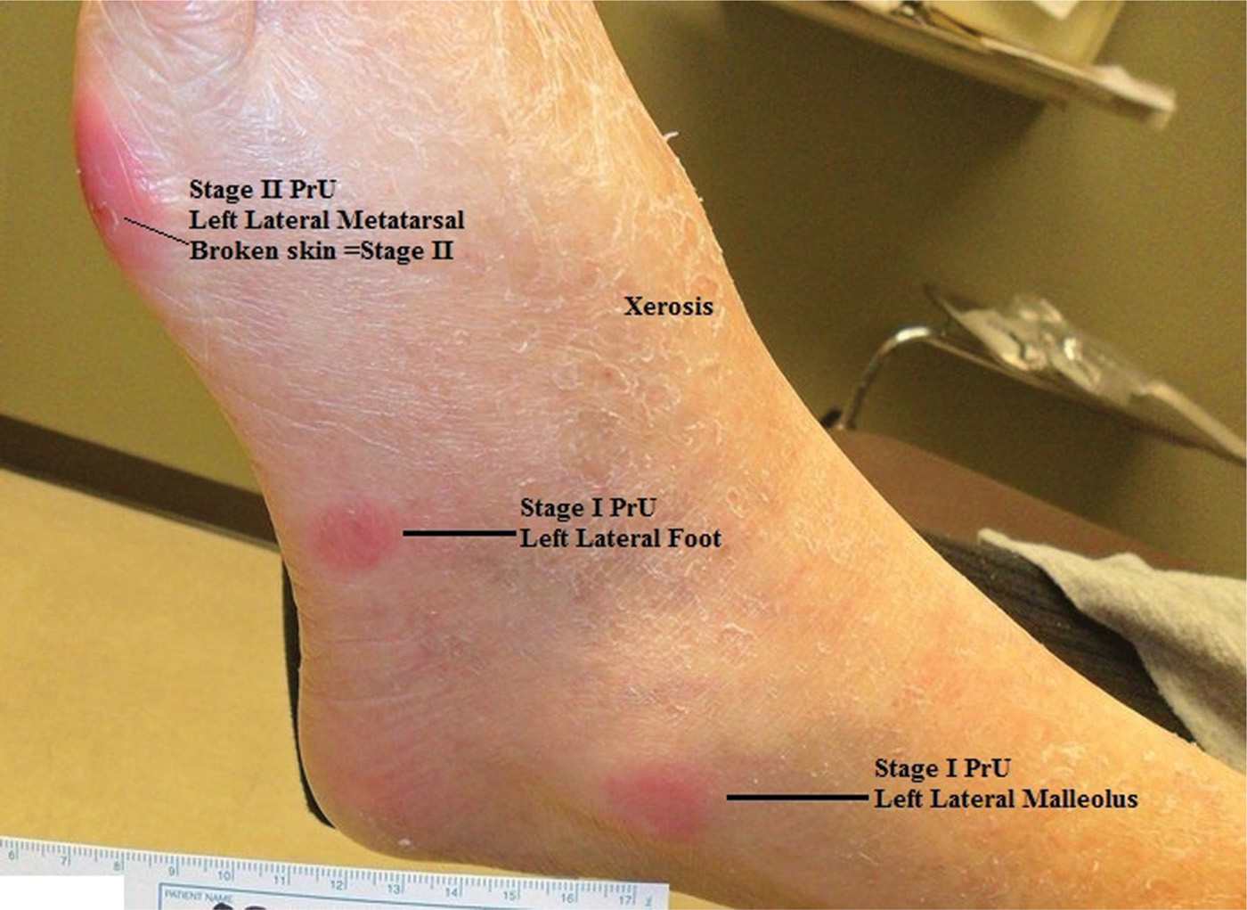 Pressure Ulcer Dressing