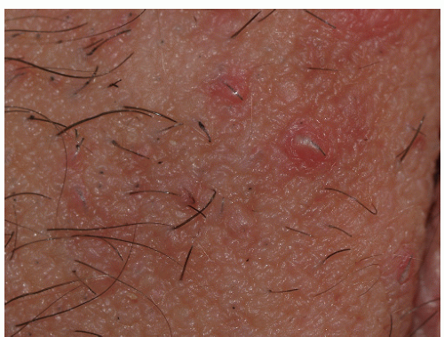 Transient Neonatal Pustular Melanosis: Background ...