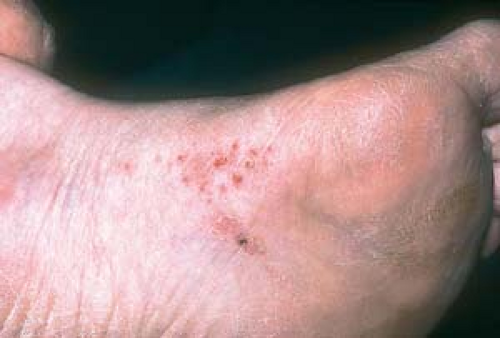 Topical Treatment of Common Superficial Tinea Infections ...