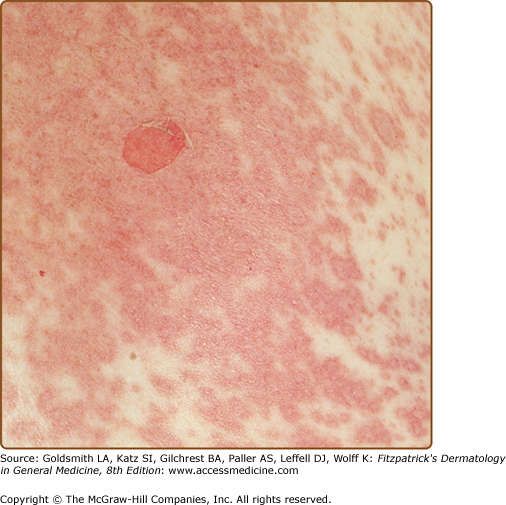 epidermal-necrolysis-stevens-johnson-syndrome-and-toxic-epidermal