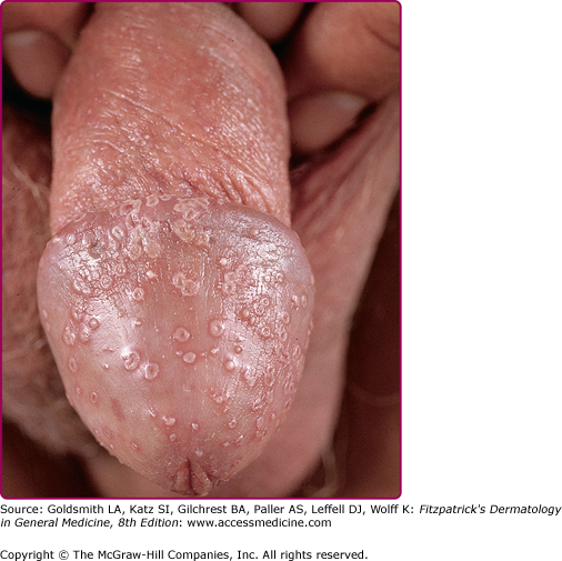 Pustules On Penis 38