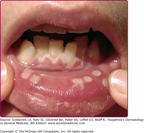 Tongue Herpes - What You Should Know - dental health advice