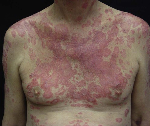 Lupus erythematosus - Wikipedia