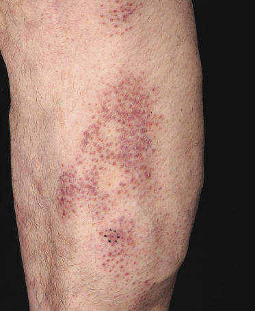 What is mycosis fungoides?
