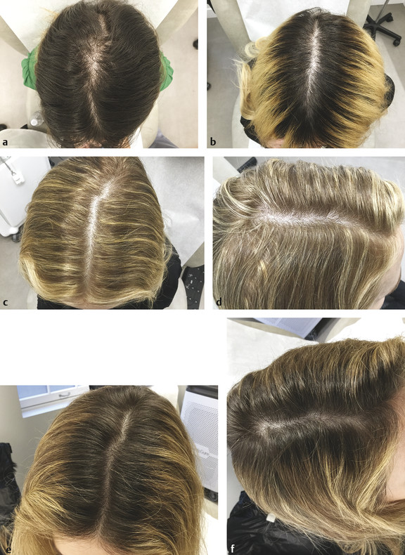 Platelet-rich plasma (PRP) used in female hair loss—before and after. Patient 1 (a) prior to PRP and (b) 4 months post treatment. Patient 2 (c, d) prior to PRP and (e, f) 4 months post treatment.