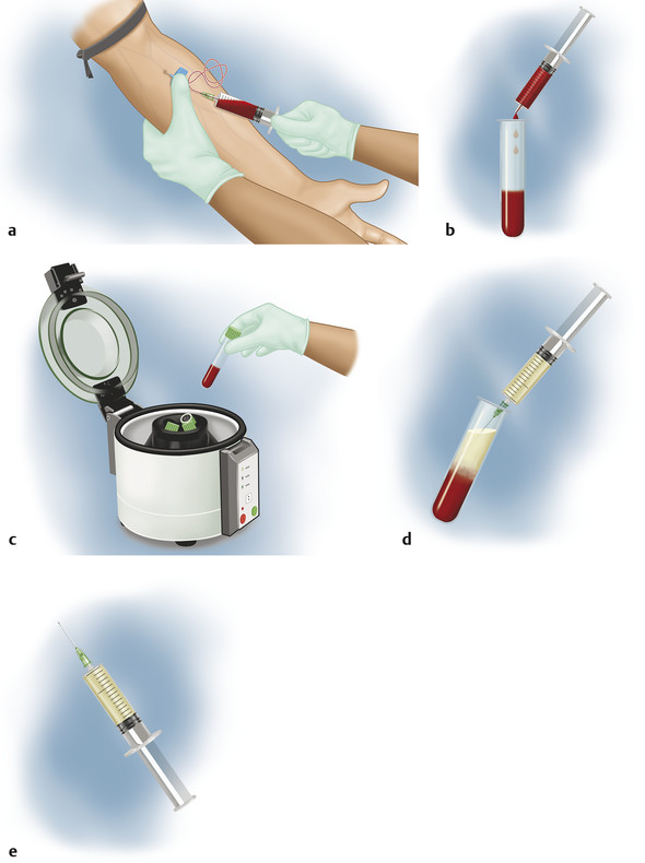 Steps for platelet-rich plasma (PRP) collection in single spin method. (a) Step 1: blood collection—venipuncture from antecubital vein. (b) Step 2: transfer blood into collection tubes for centrifugat