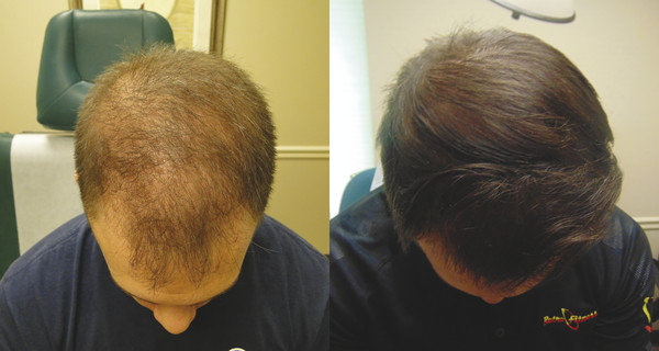 Before and after 9 PRP treatments in a 29-year-old male.