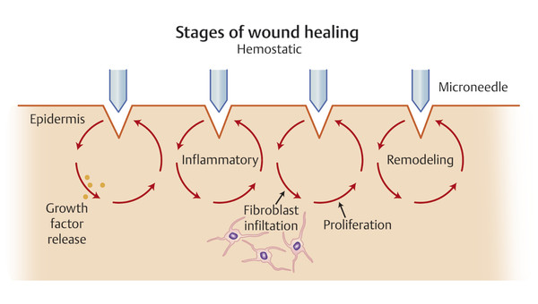 Fractional mechanical microinjury hypothesis for the mechanism of action in microneedling. Tiny, superficial wounds form a strong stimulus for growth factor release and fibroblast infiltration followi