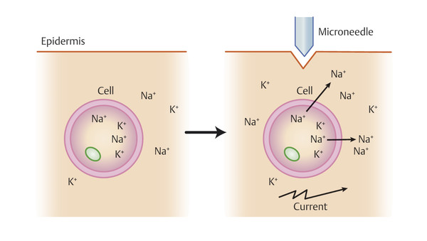 Demarcation current hypothesis for the mechanism of action in microneedling. En masse changes in cell membrane potential create bioelectrical current that changes DNA synthesis and growth factor produ