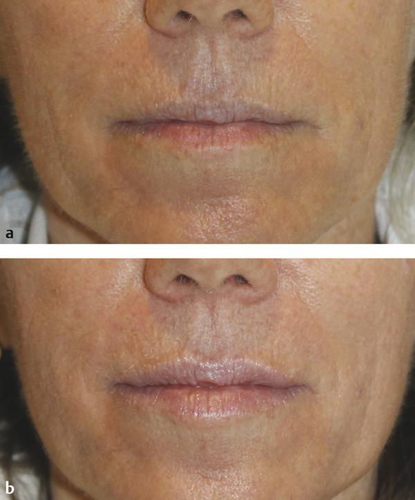Perioral rhytides at (a) baseline and (b) 3 months after one microneedling session.
