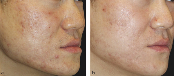 Atrophic facial acne scars at (a) baseline and (b) 6 months after three microneedling sessions at monthly intervals.
