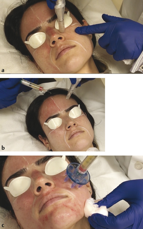 Microneedling with PRP. (a) The microneedling device is first used to create minute puncture wounds. (b) Topical PRP is then applied to the skin using a syringe. (c) Alternatively, PRP can be injected