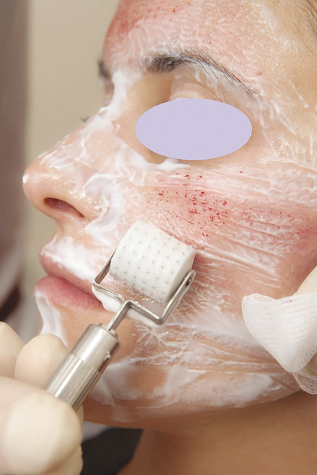 Patient immediately after microneedling to a depth of 1 mm illustrating erythema and pinpoint bleeding.