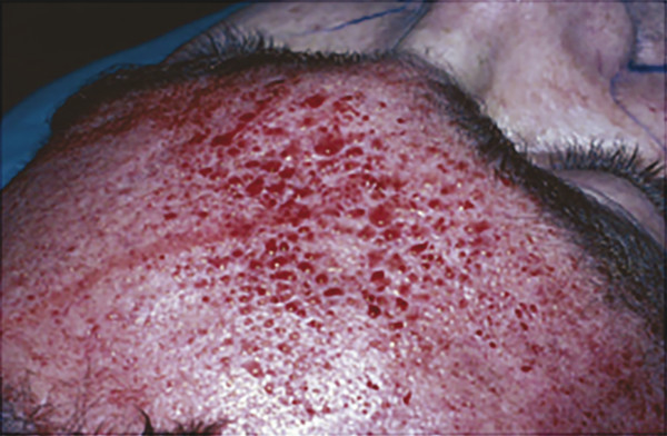 Patient immediately after microneedling to a depth of 3 mm.