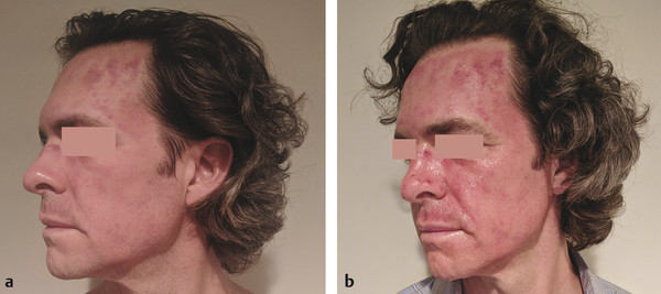 (a, b) Patient at days 1 and 2 post-microneedling with topical platelet-rich plasma.