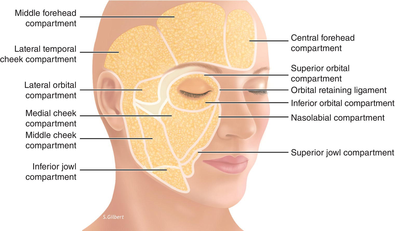 3D Diagram of a woman’s face illustrating the superficial fat compartments with lines marking middle forehead compartment, lateral temporal cheek compartment, lateral orbital compartment, etc.
