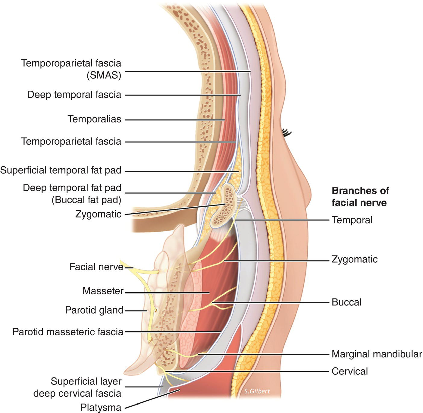 3D Diagram illustrating the relationship of the facial fasciae in the lateral cheek/temporal region with lines marking temporoparietal fascia (SMAS), deep temporal fascia, temporalias, temporoparietal fascia, etc.