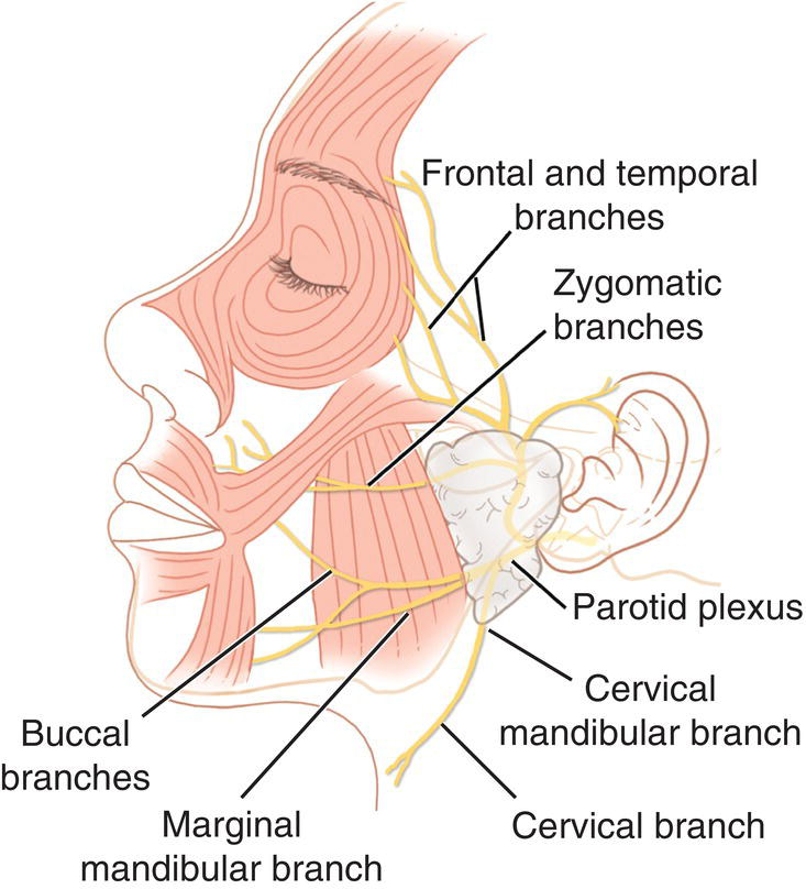 Diagram of a face (side view) illustrating relationship of the facial nerve to the underlying facial musculature with lines marking temporal branches, zygomatic branches, parotid plexus, buccal branches, etc.