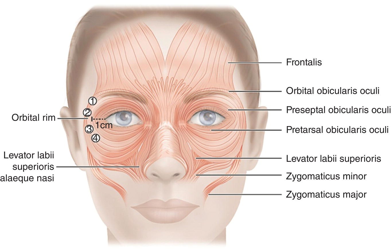 Illustration of a human face with lines marking frontalis, orbital obicularis oculi, preseptal obicularis oculi, pretarsal obicularis oculi, levator labii superioris, zygomaticus minor, orbital rim, etc.