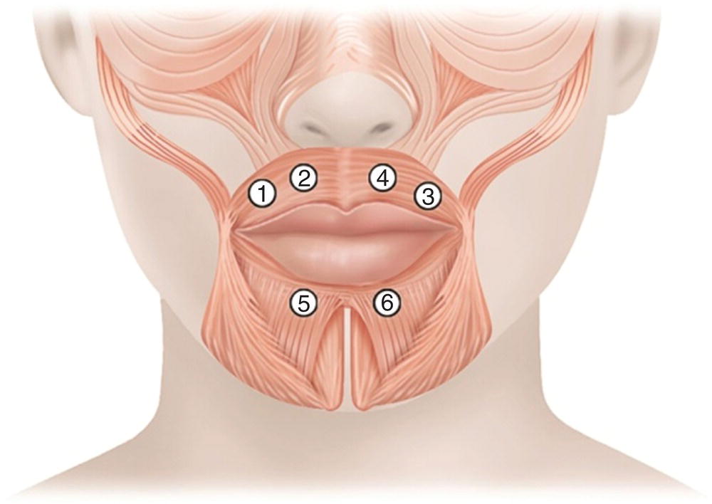 Illustration of the injections sites for radial lines around the lips. Sites 1, 2, 4, and 3 are indicated above the upper lip and sites 5 and 6 below the lower lip.