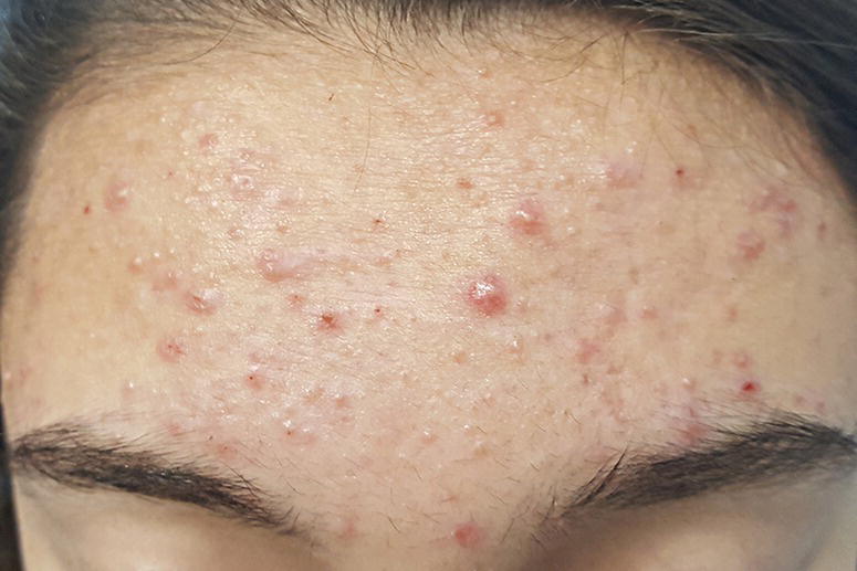 Moderate acne, with comedonal and papulopustular lesions on the forehead of a person.