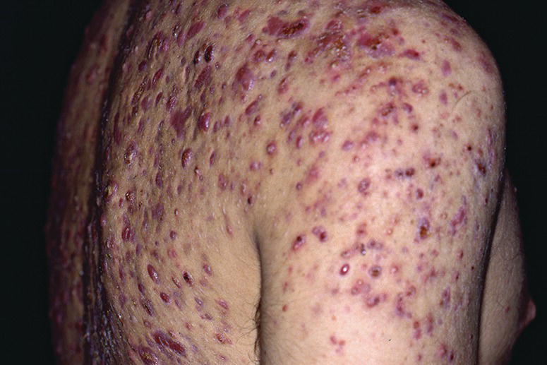 Side view of a person’s upper body with nodulocystic acne.