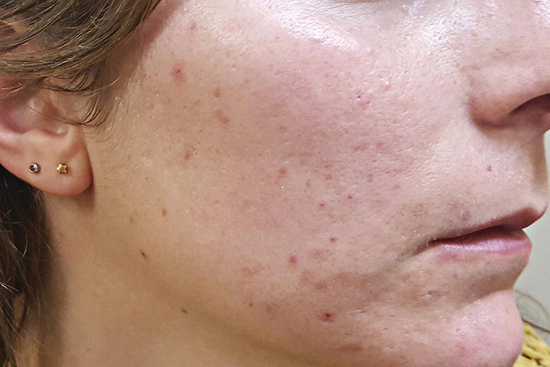 Side view of a person’s face with Acne excoriée.