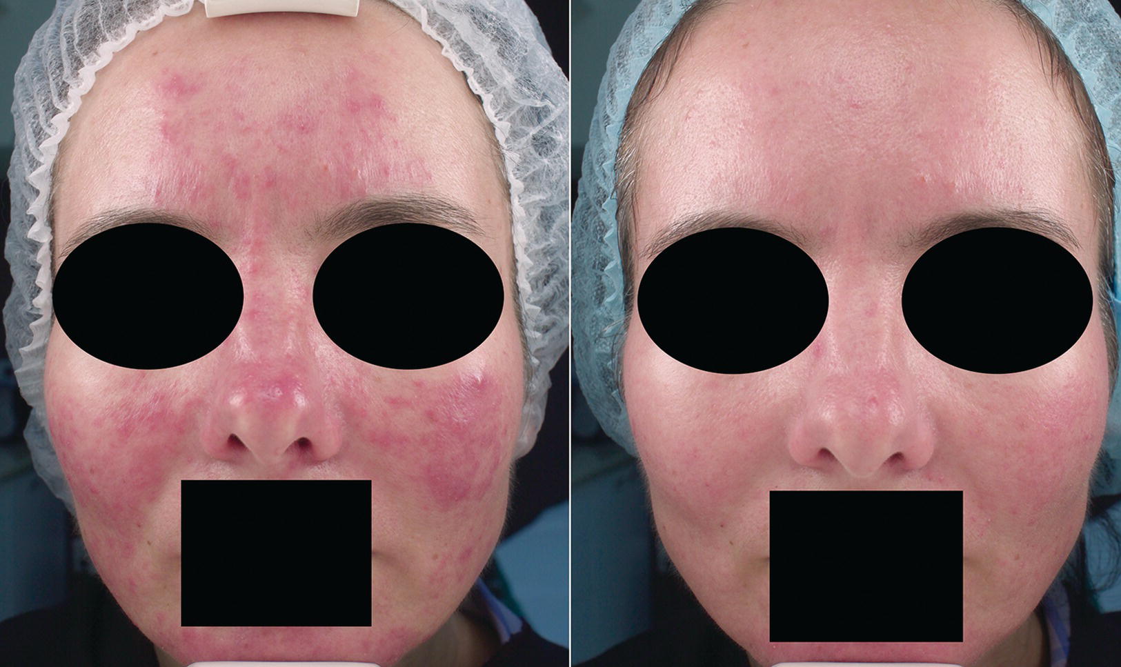 Close-up view of a middle‐aged woman’s face with (left) and without (right) rosacea. Eyes and mouth are covered with shaded ovals and rectangle, respectively.