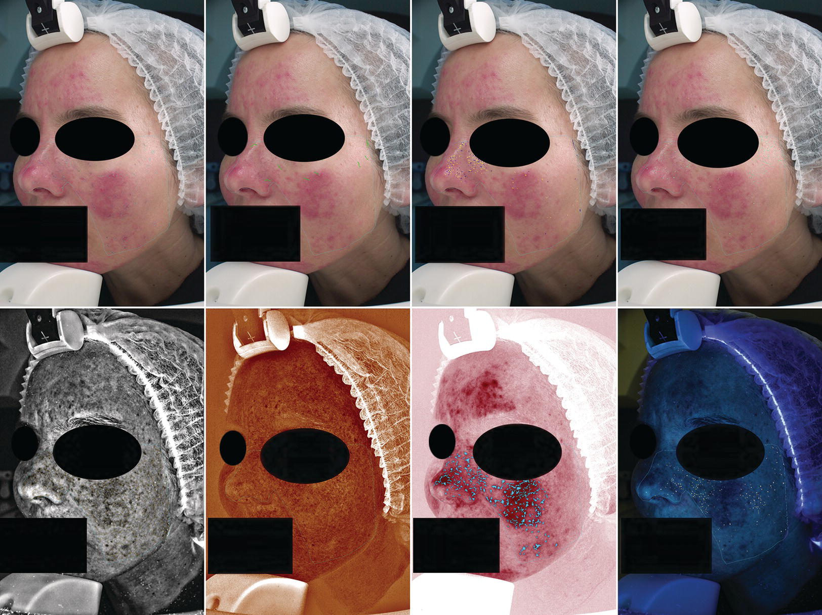 4 Photos of the left side view of a middle‐aged woman’s face with rosacea (top panel) and 4 corresponding laser images of different shades (bottom panel).