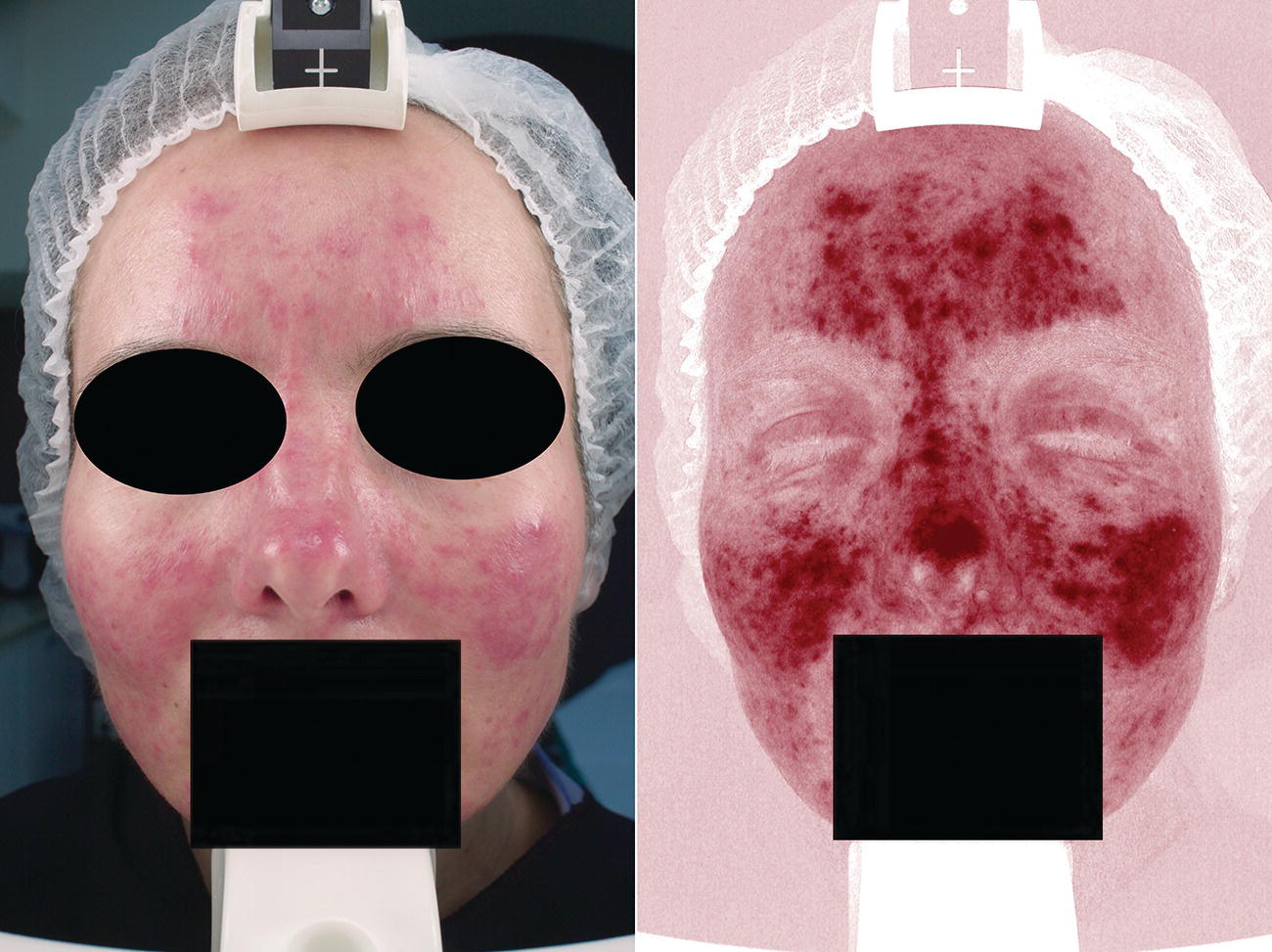 Close-up view of a middle‐aged woman’s face (left) and its corresponding laser image (right). Eyes and mouth are covered with shaded ovals and rectangle, respectively.