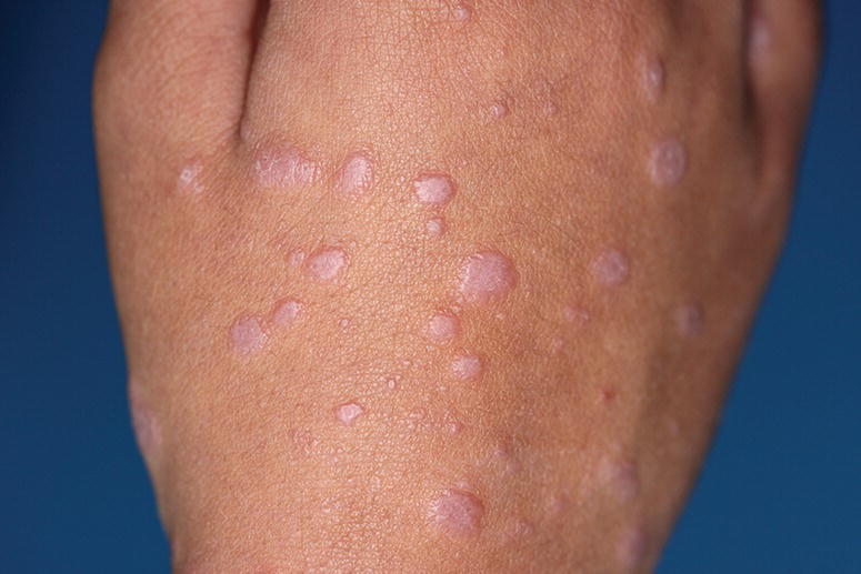 Photo displaying classical erythematous to violaceous, flat‐topped, polygonal papules of CLP in a hand.