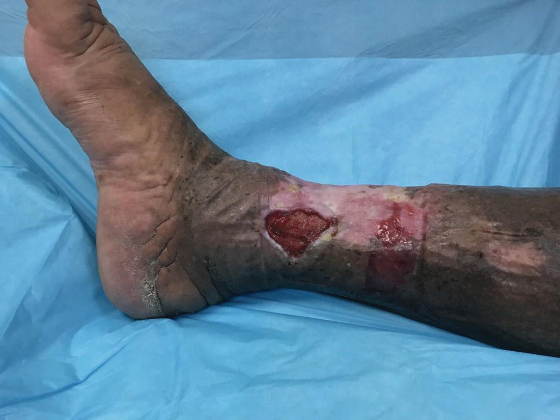 Venous starburst of veins radiating from the medial malleolus (corona phlebectatica paraplantaris) and/or ulcers in a patient’s leg.