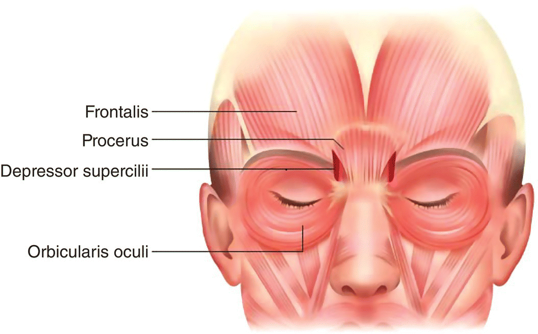 Illustration displaying the anatomy of Corrugator supercilii and procerus muscle, with parts labeled frontalis, procerus, depressor supercilii, and orbicularis oculi.