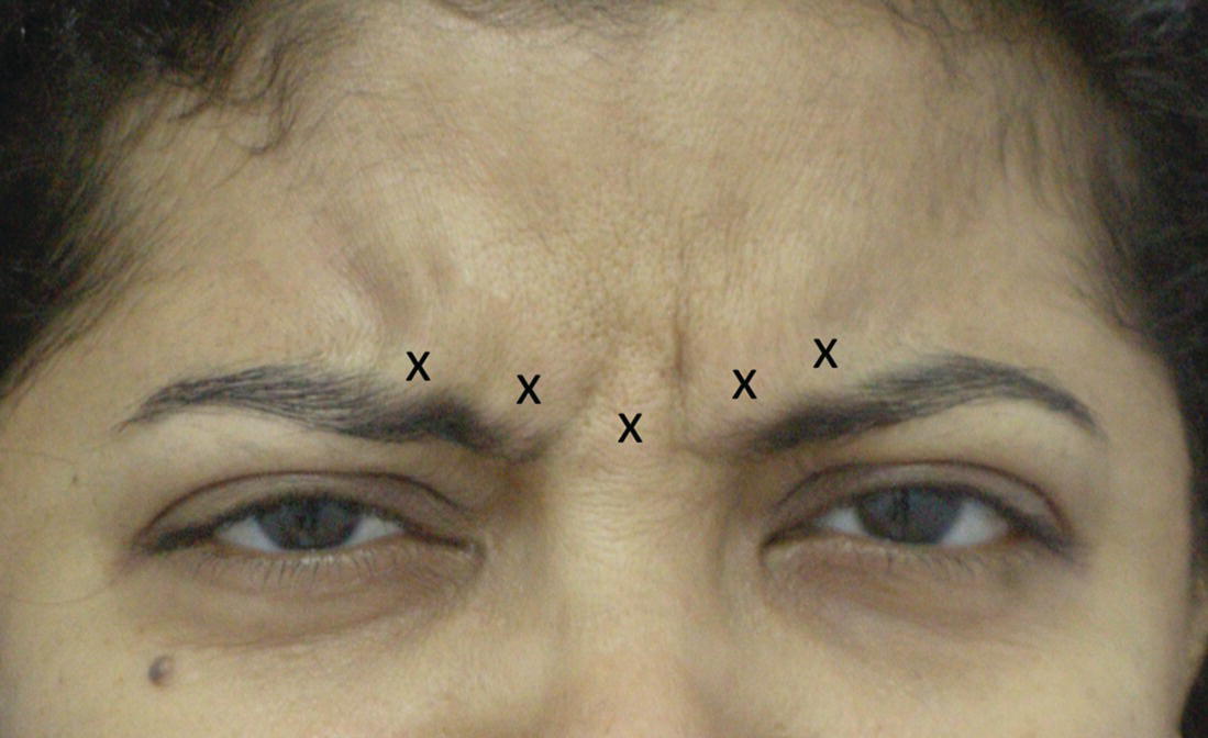 Photo displaying the upper-half face of a woman with injection points for glabellar frown lines, indicated by X markers.
