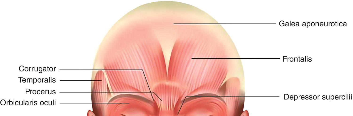 Illustration displaying the frontalis muscle anatomy, with parts labeled corrugator, temporalis, procerus, orbicularis oculi, galea aponeurotica, frontalis, and depressor supercilii.