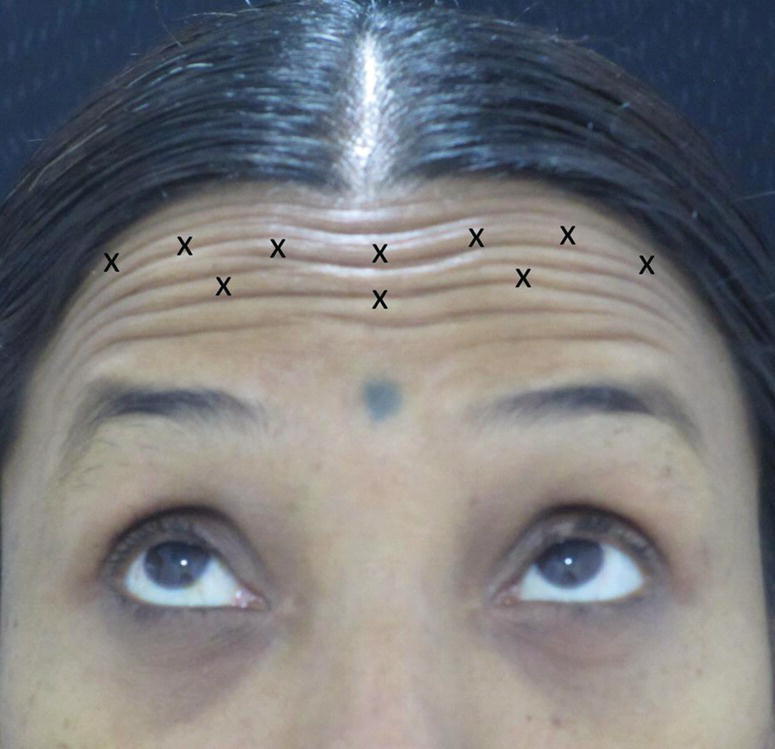 A close-up view of a woman elevating her eyebrows with forehead lines having “X” marks depicting the injection points.