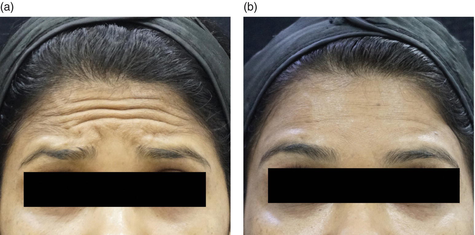 A close-up view of a woman with forehead lines depicting before injection (left) and less forehead lines depicting after injection (right).