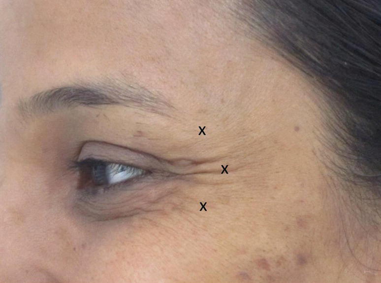 A close-up view of a woman’s outer eye with crow’s feet having “X” marks indicating injection points.