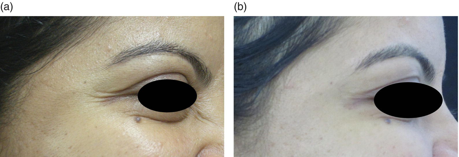 A close-up view of a woman’s outer eye with crow’s feet before BoNT injection (left) and less crow’s feet after BoNT injection (right).