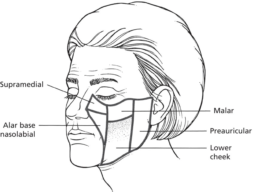 Diagram of the anterolateral view of the face with lines indicating preauricular, malar, lower cheek, alar base nasolabial, and supramedial.