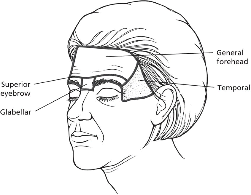Diagram of the anterolateral view of the face with lines indicating superior eyebrow, glabellar, general forehead, and temporal.