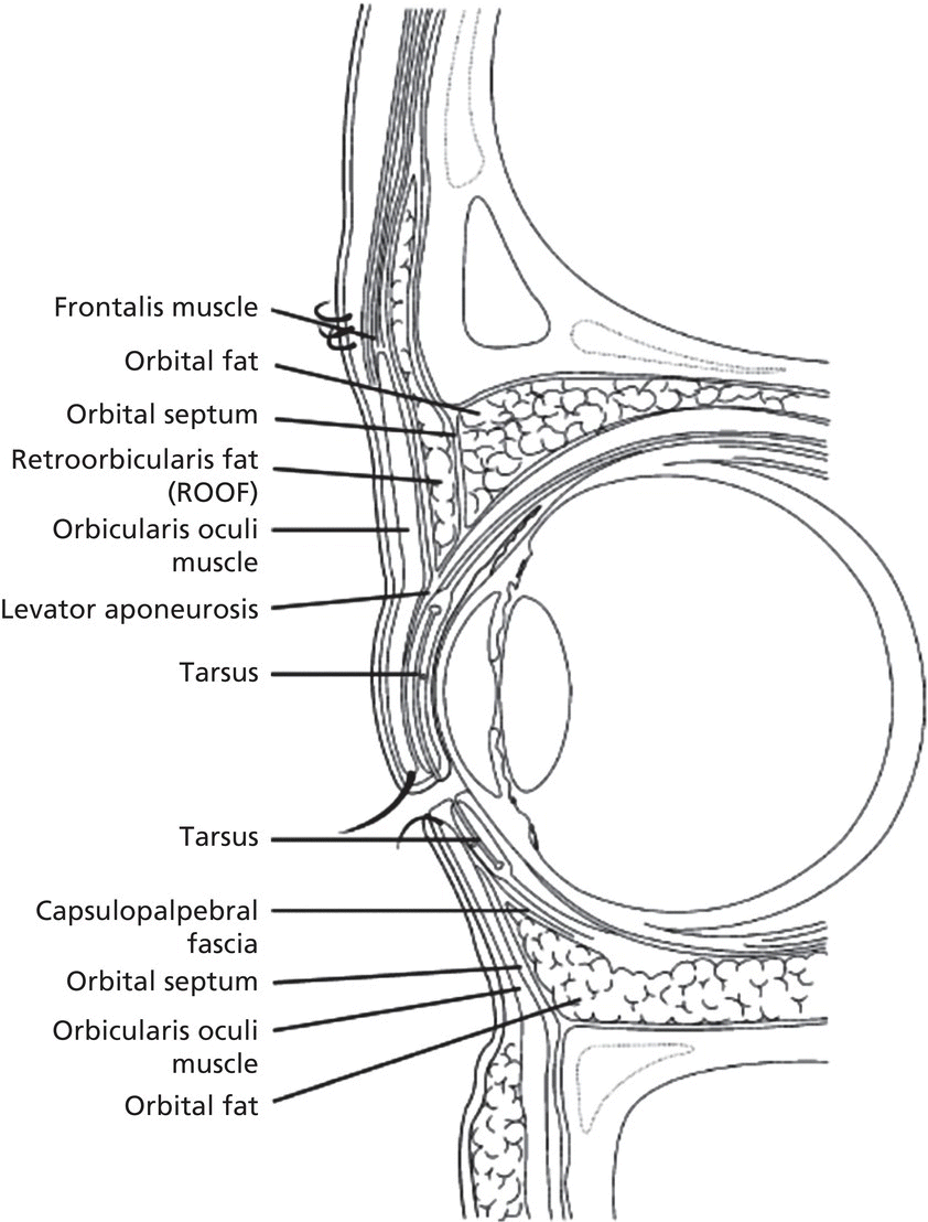Diagram displaying a lateral cross section of the eye with lines marking the frontalis muscle, orbital fat, orbital septum, retroorbicularis fat, orbicularis oculi muscle, levator aponeurosis, tarsus, etc.