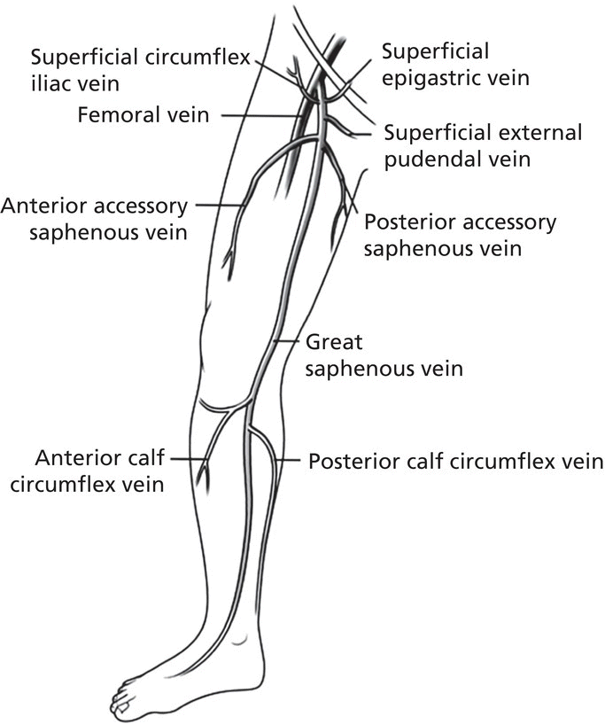 Diagram displaying the anatomy of the lower extremity venous system, with lines marking the superficial circumflex iliac vein, femoral vein, anterior lateral tributary, anterior tributary vein, etc.