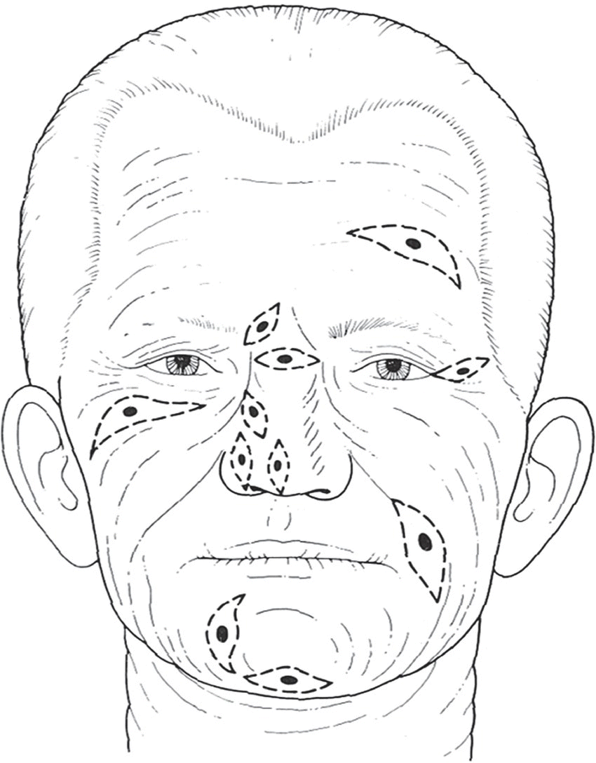Diagram illustrating RSTL on the human face displaying orientation of simple linear closure (depicted by leaf-like shapes with shaded ellipses at the center).
