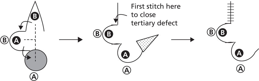 Schematic with 3 irregular shapes linked by arrows, depicting a bilobed flap. Each has 4 circle markers paired into shaded and unshaded labeled 1 and 2.